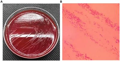 Maternal puerperal infection caused by Parabacteroides goldsteinii: a case report